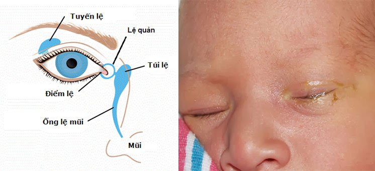 CHĂM SÓC MẮT TRẺ EM CƠ BẢN