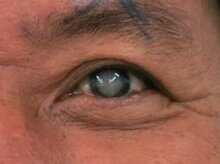 KHI NÀO THÌ NGHI NGỜ BỊ BỆNH CƯỜM KHÔ?