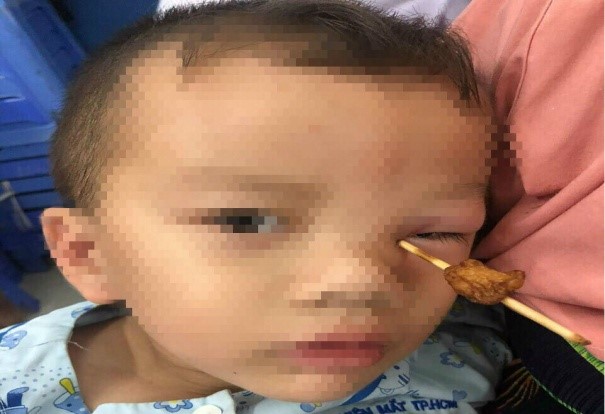 CHĂM SÓC MẮT Ở TRẺ NHỎ, TUỔI ĐI HỌC